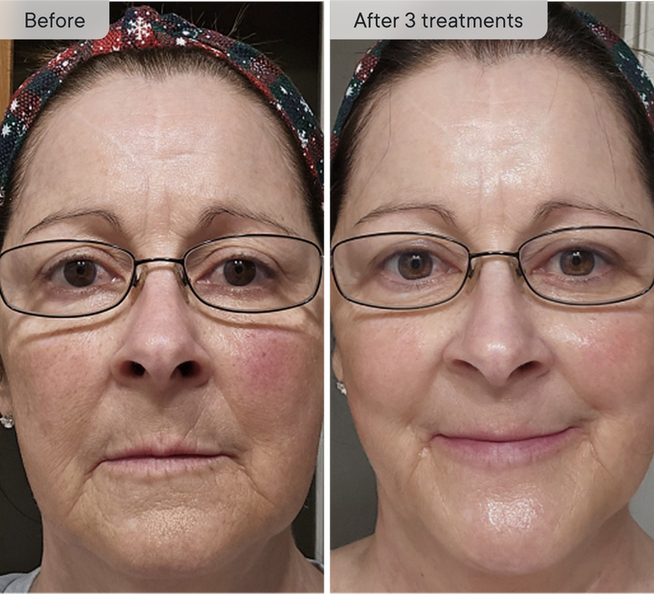 Refresh the look of dull skin with the Micro-Infusion Facial System